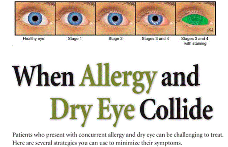 Dry Eye And Ocular Allergy Emednews 