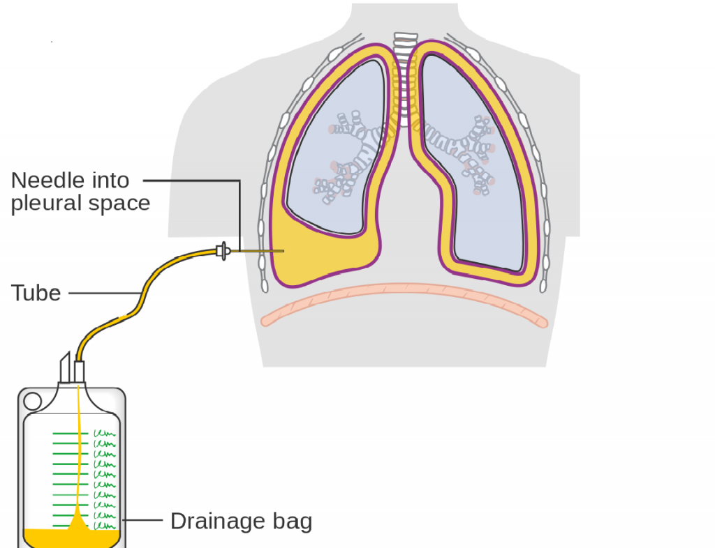 Pleural Fluid Drainage Frequency - eMedNews