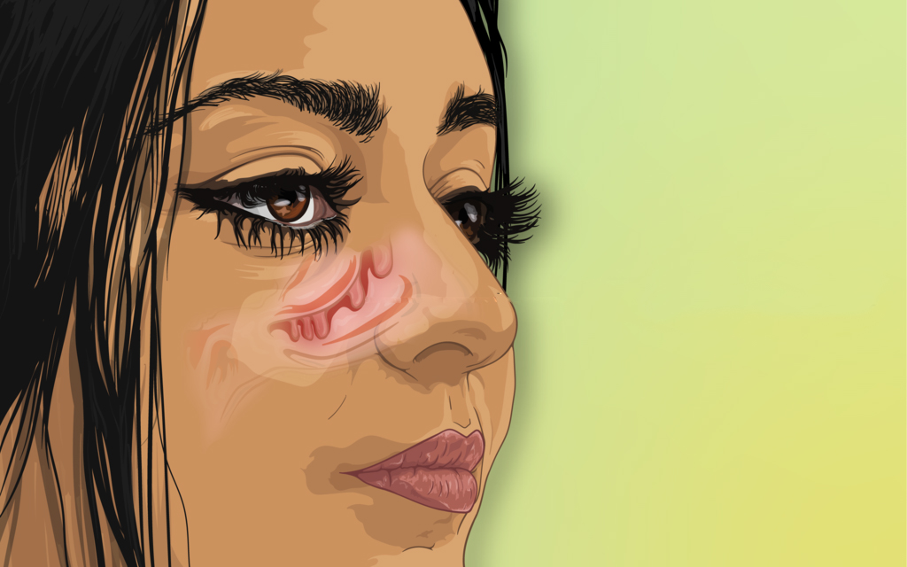 Biologic therapy effective for chronic rhinosinusitis eMedNews