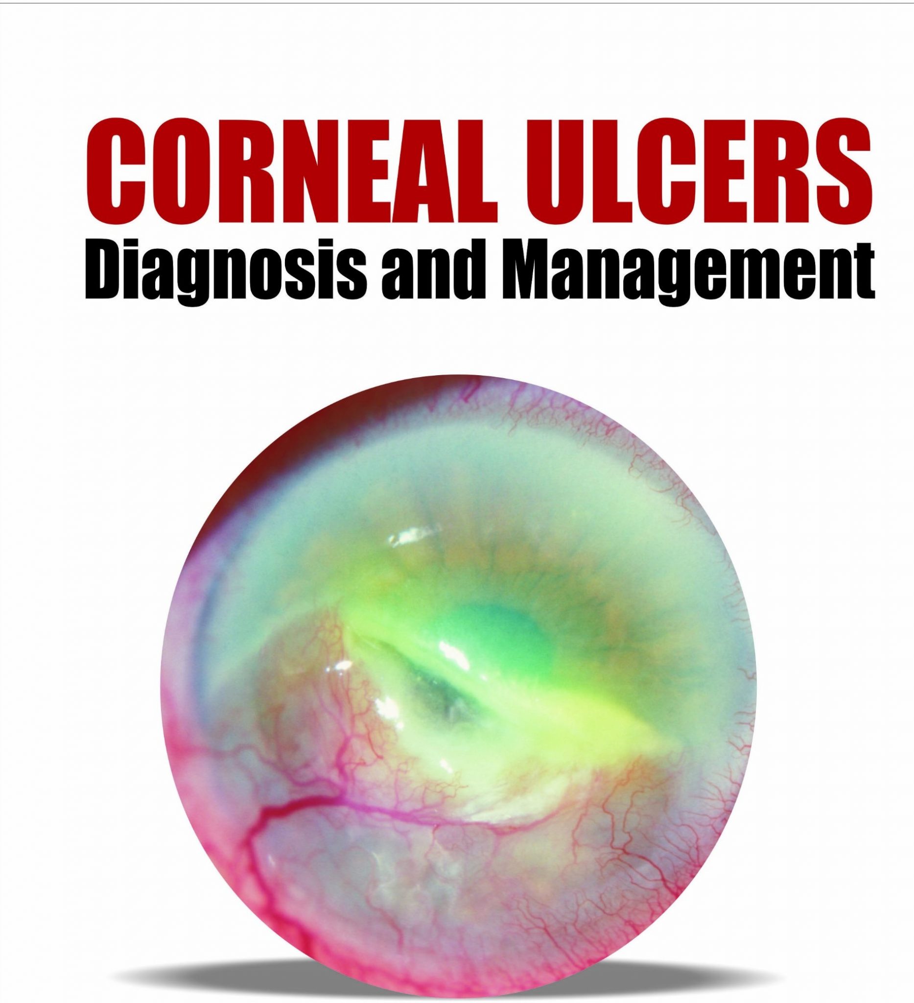 Corneal Ulcer Diagnosis & Treatment eMedNews