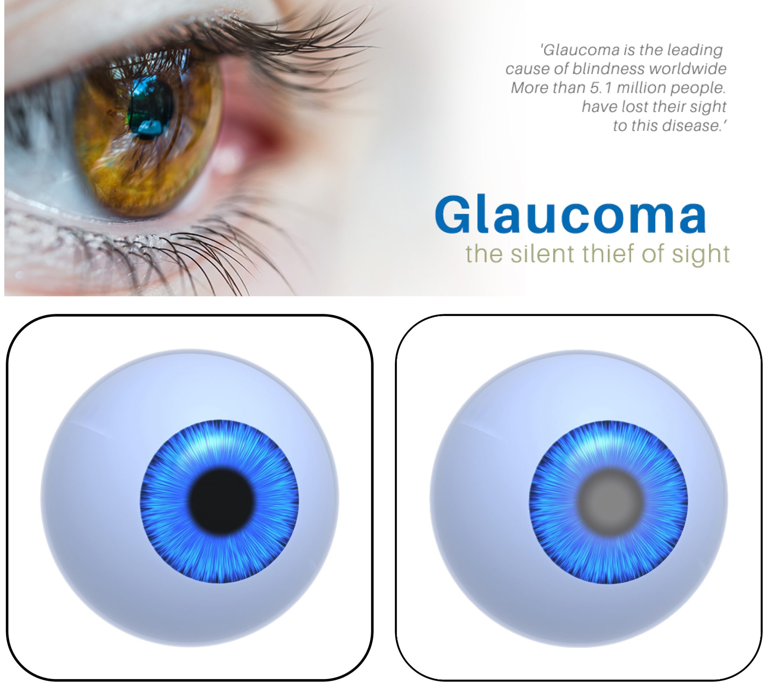 Unveiling The Double Mask Of & Intraocular pressure (IOP