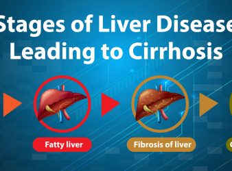 Fatty liver causes liver cirrhosis