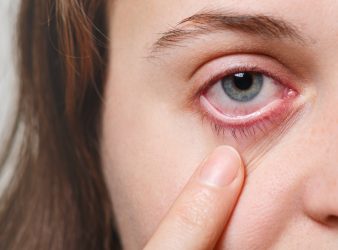 Anti-VEGF Drug for Eye Inflammation