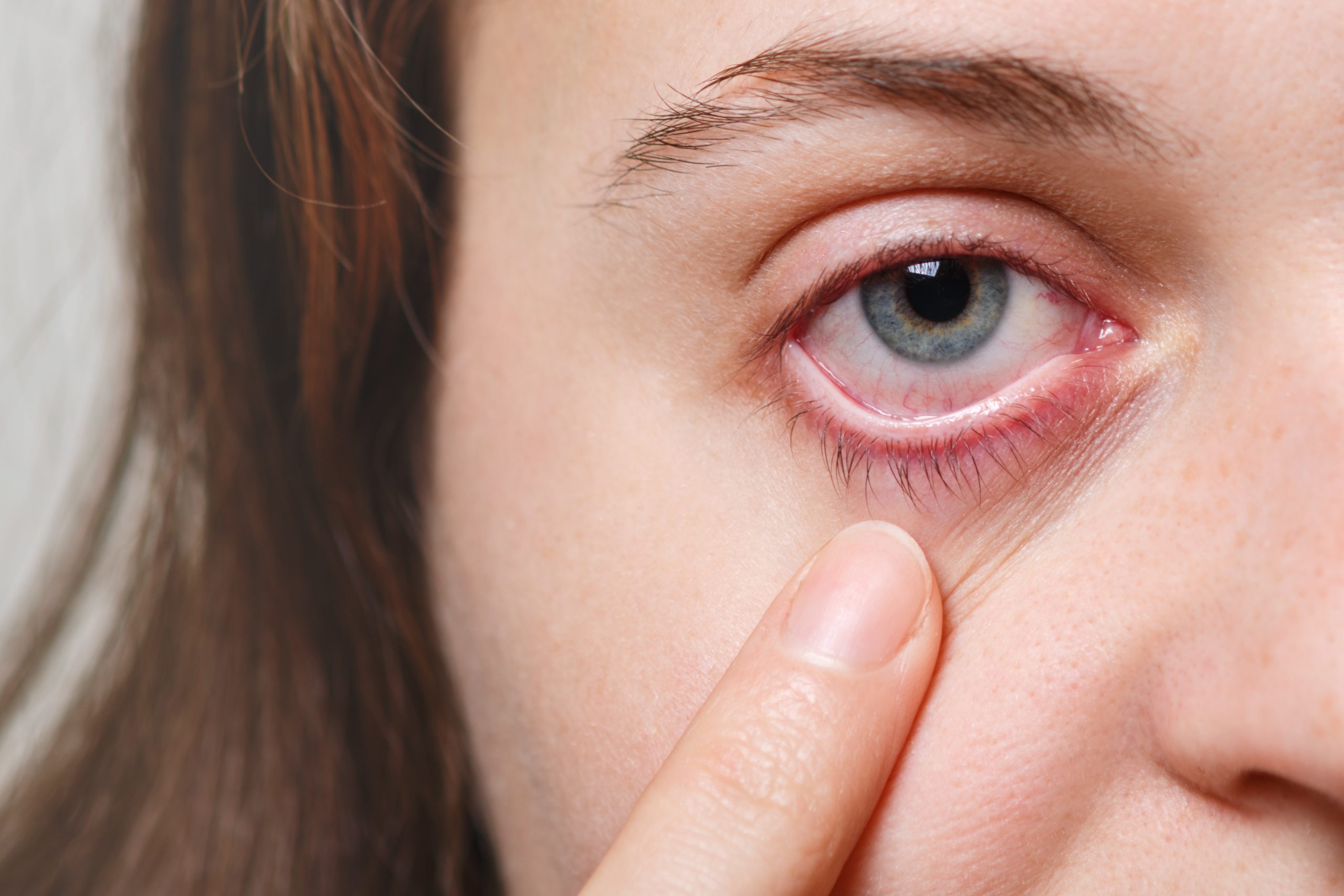 Anti-VEGF Drug for Eye Inflammation