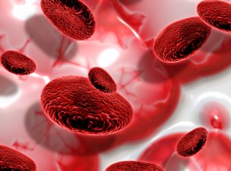 myelodysplastic syndromes