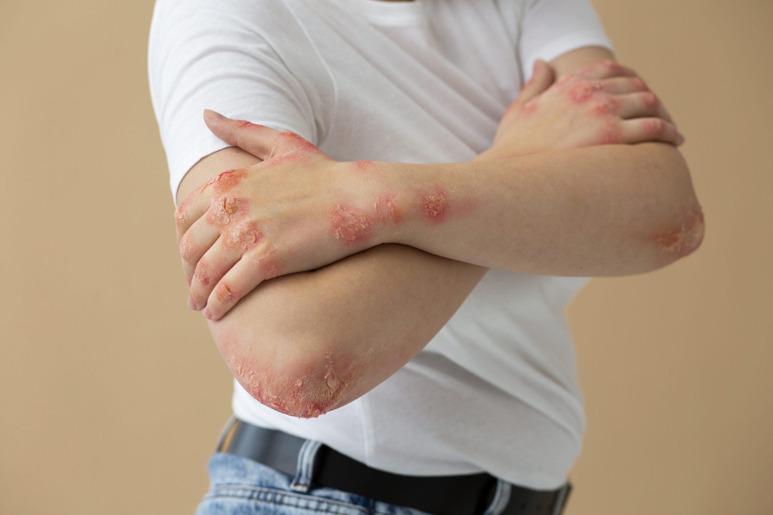 Eczema Treatment