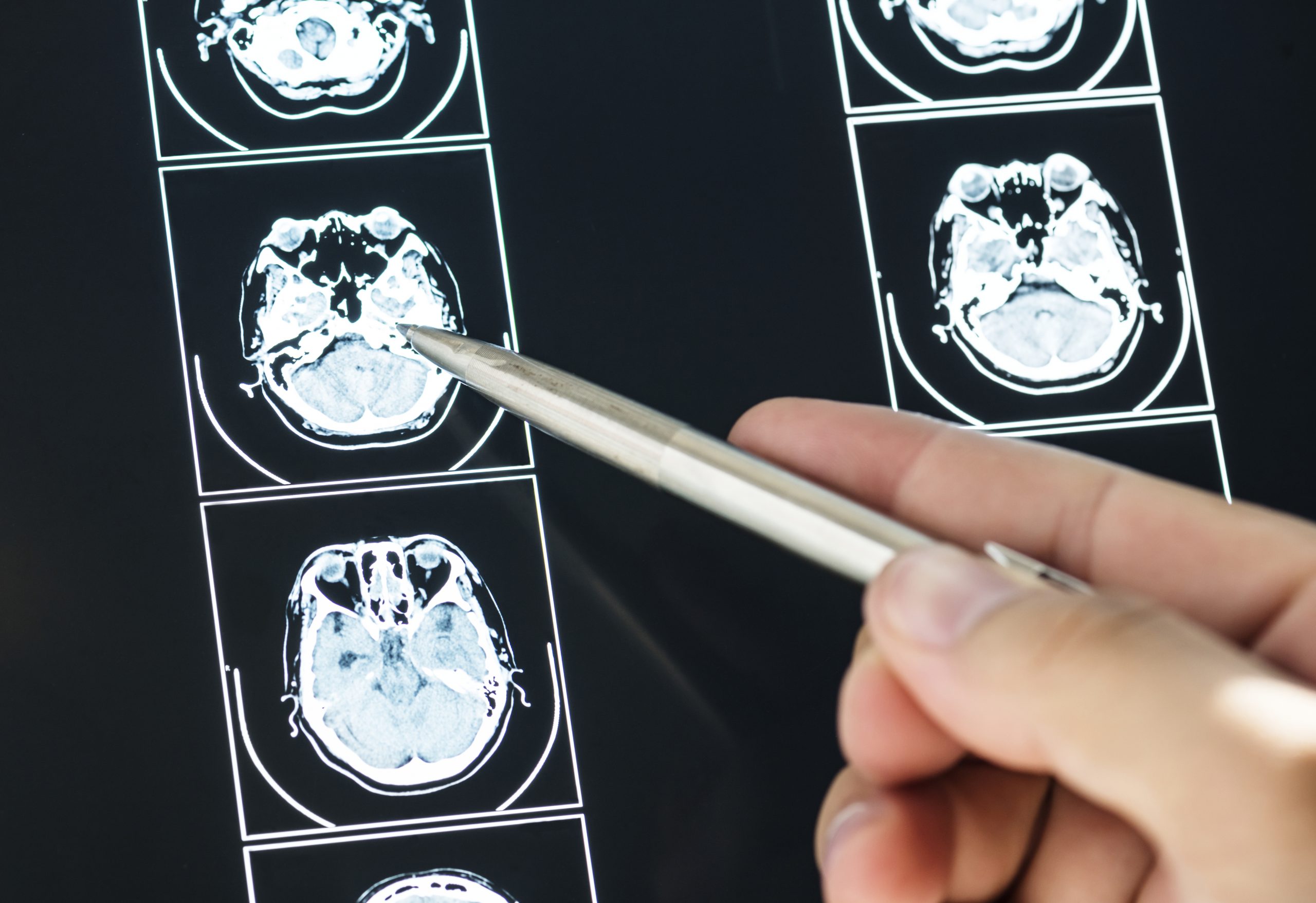 Potential treatment for Brain Tumors