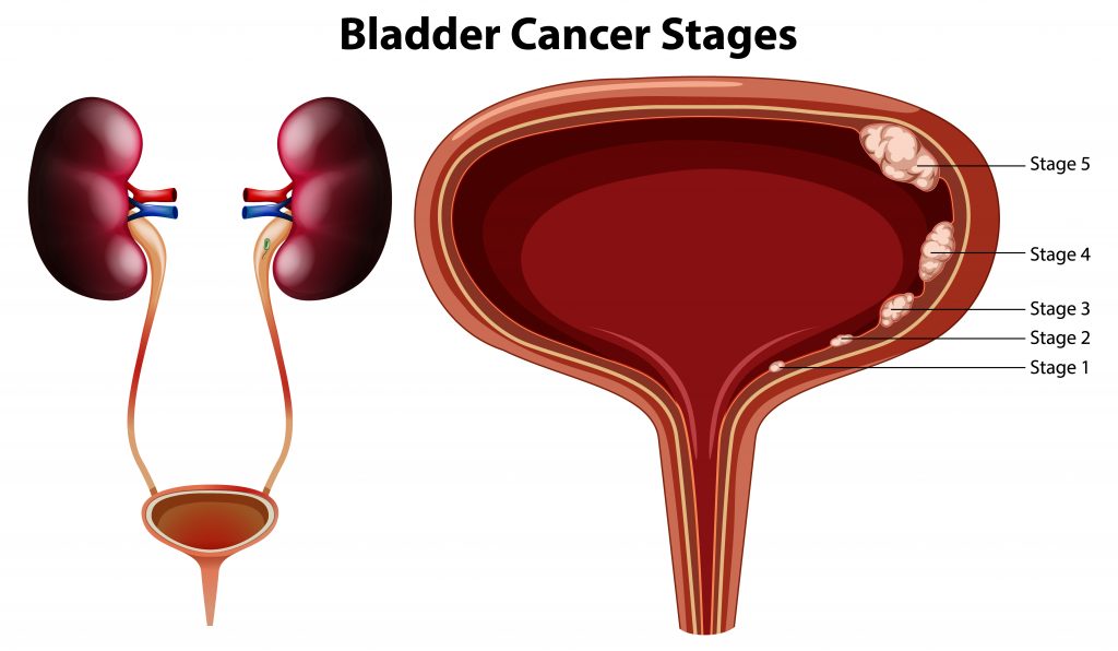 New Bladder Cancer Grouping Predicts Treatment Response - eMedNews