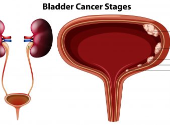 Bladder Cancer