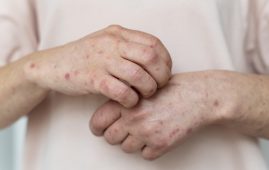 Tinea Cases in South Asia
