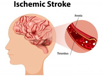 Ischemic Stroke Risk in Men and Women With Migraines