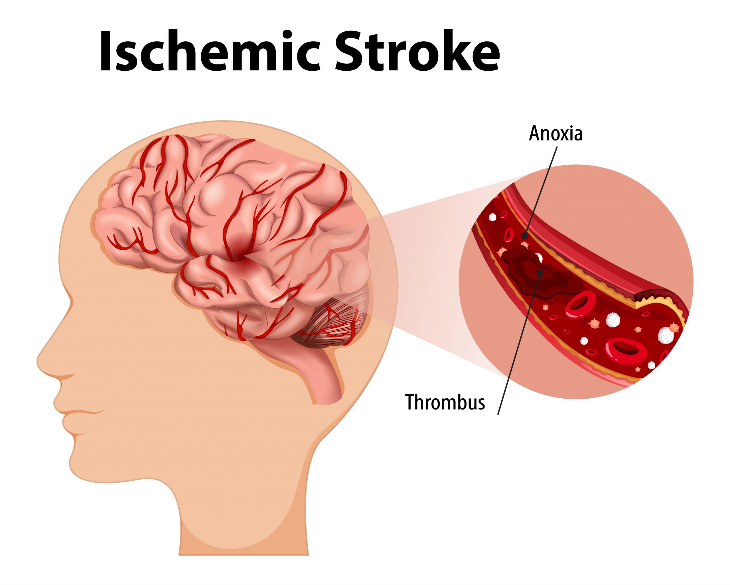 Ischemic Stroke Risk in Men and Women With Migraines