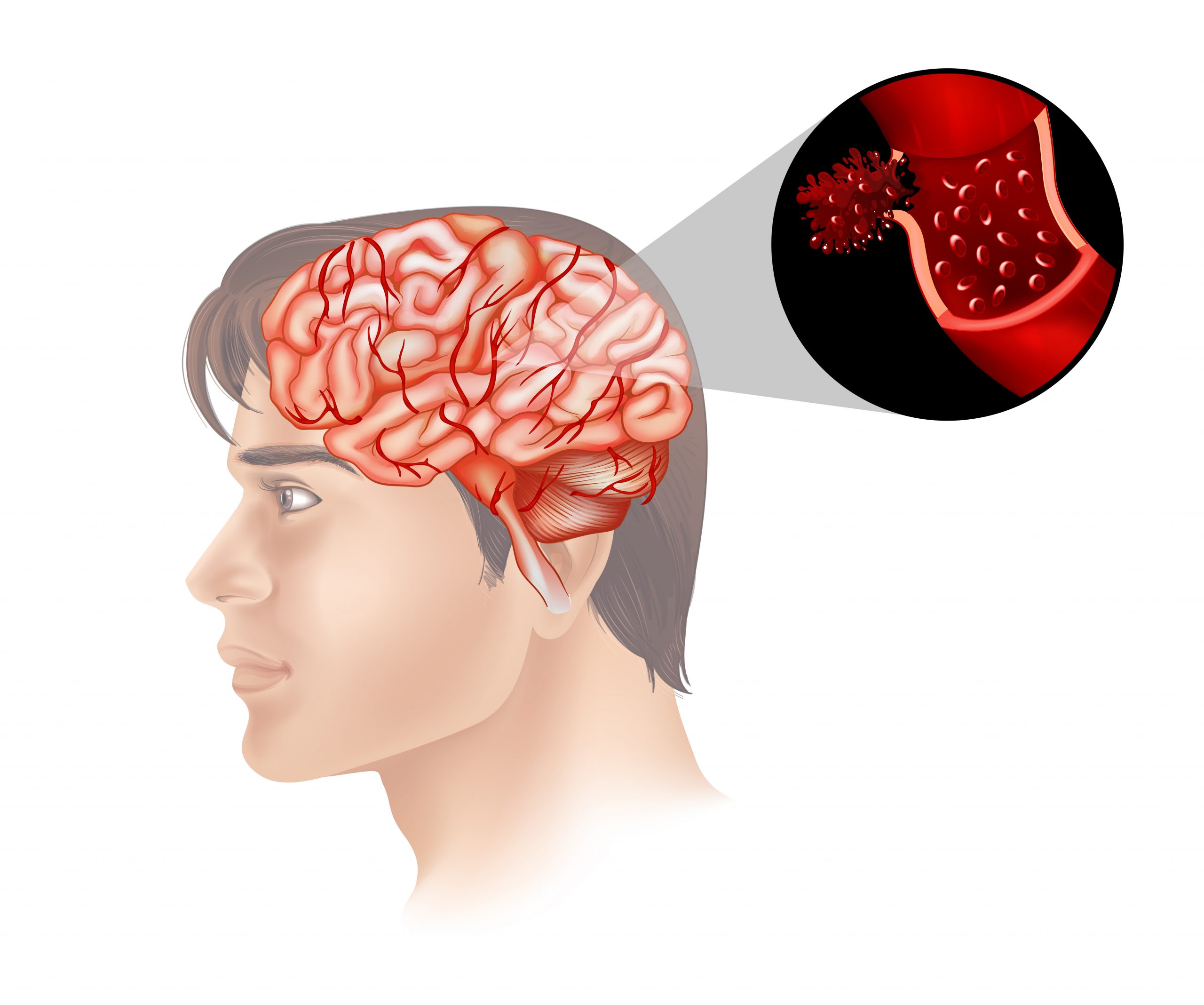 Biodegradable Ultrasound Breaks the Blood-Brain Barrier