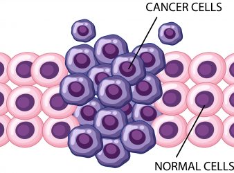 Rare Leukemia in the Skin