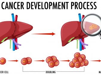 Rare Liver Cancer Proteome Illuminates Basic Biology