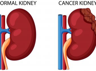 Study Sheds Light on kidney Cancer Metastasis