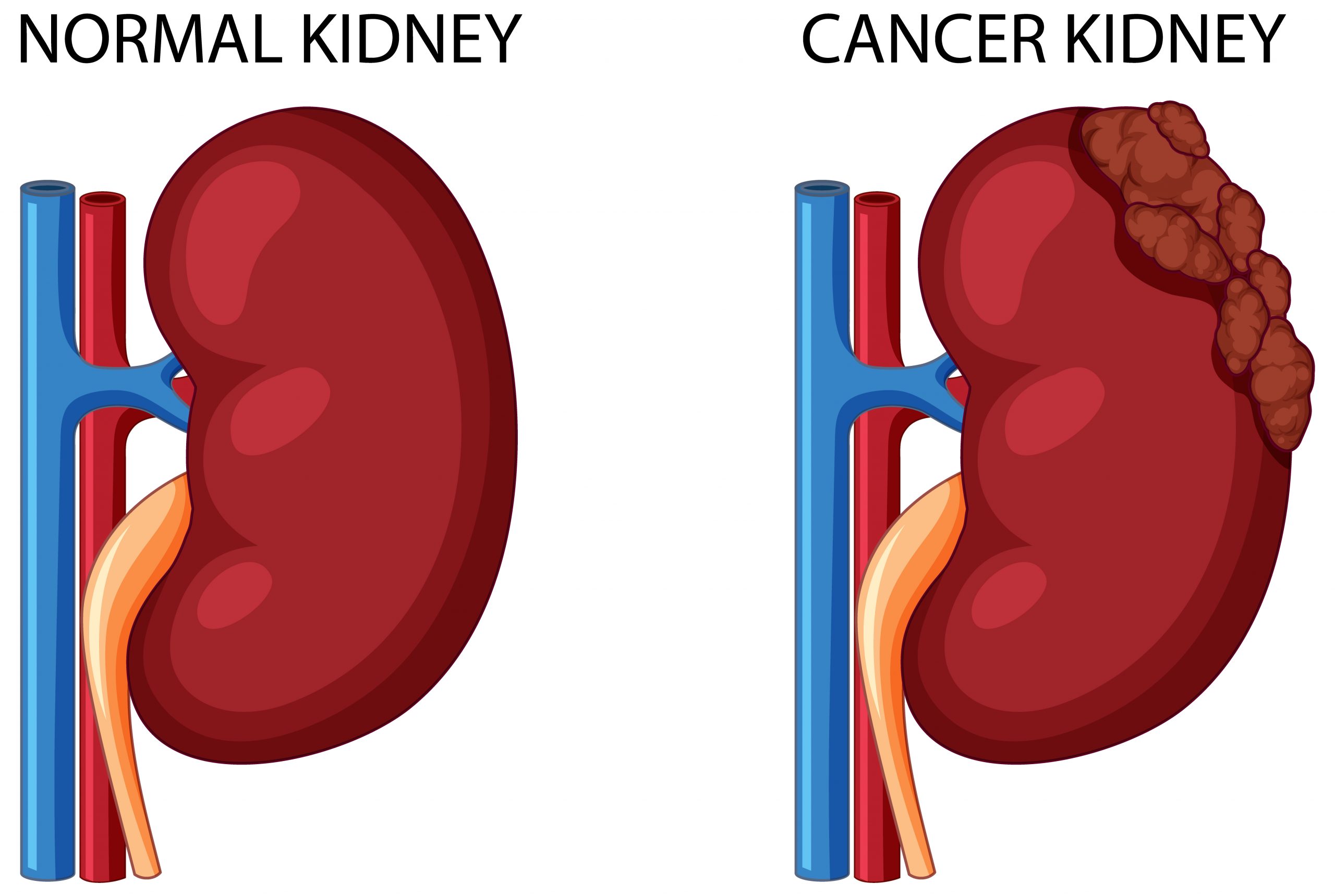 Study Sheds Light on kidney Cancer Metastasis