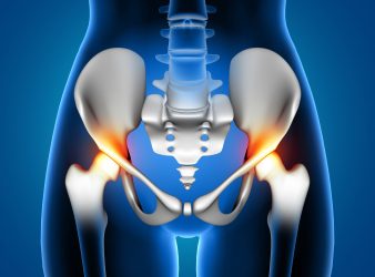 Hip Replacement is Safe for HIV Patients