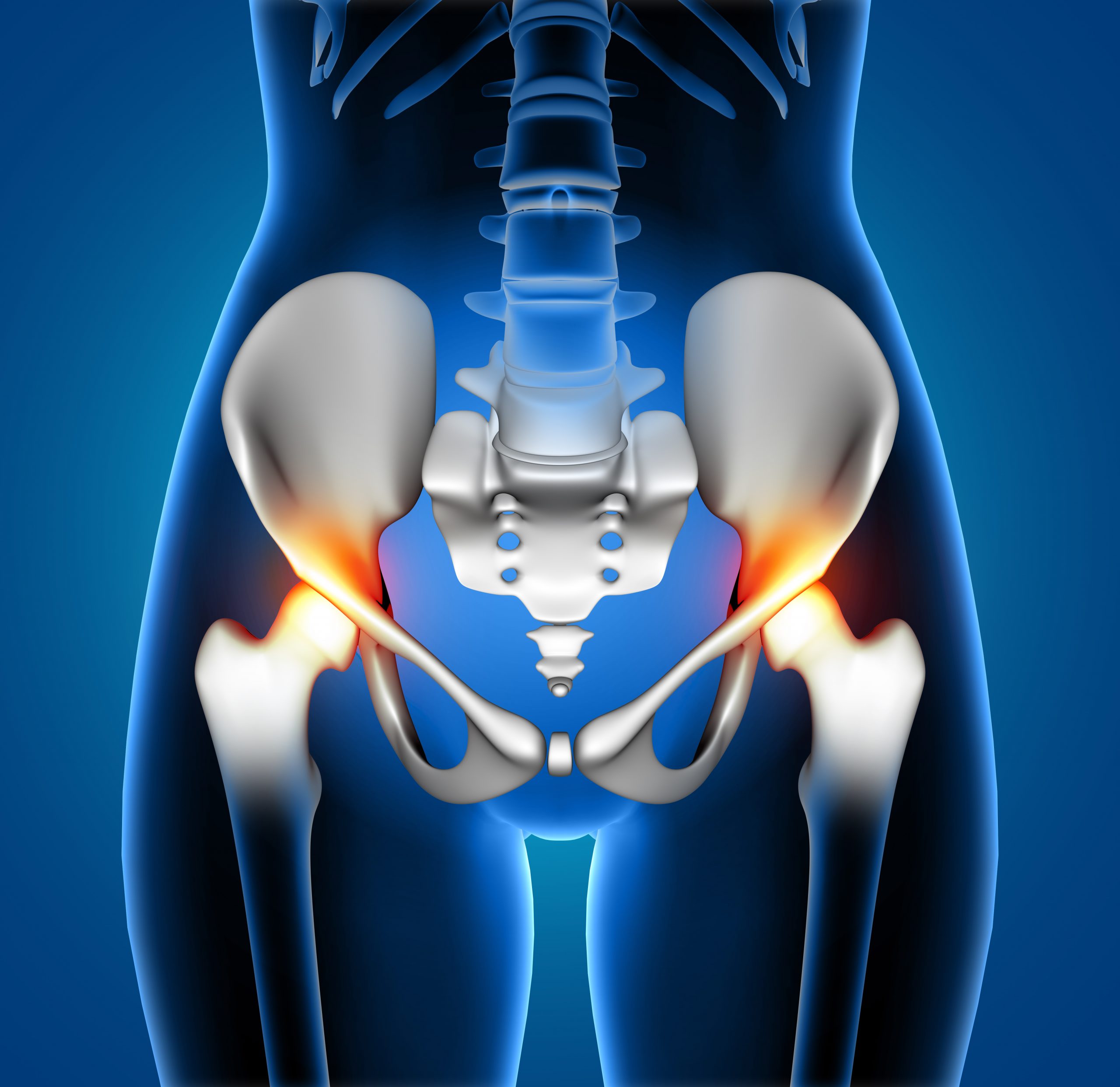 Hip Replacement is Safe for HIV Patients