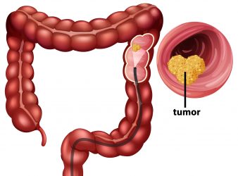 Approach to Metastases Classification in Colorectal Cancer