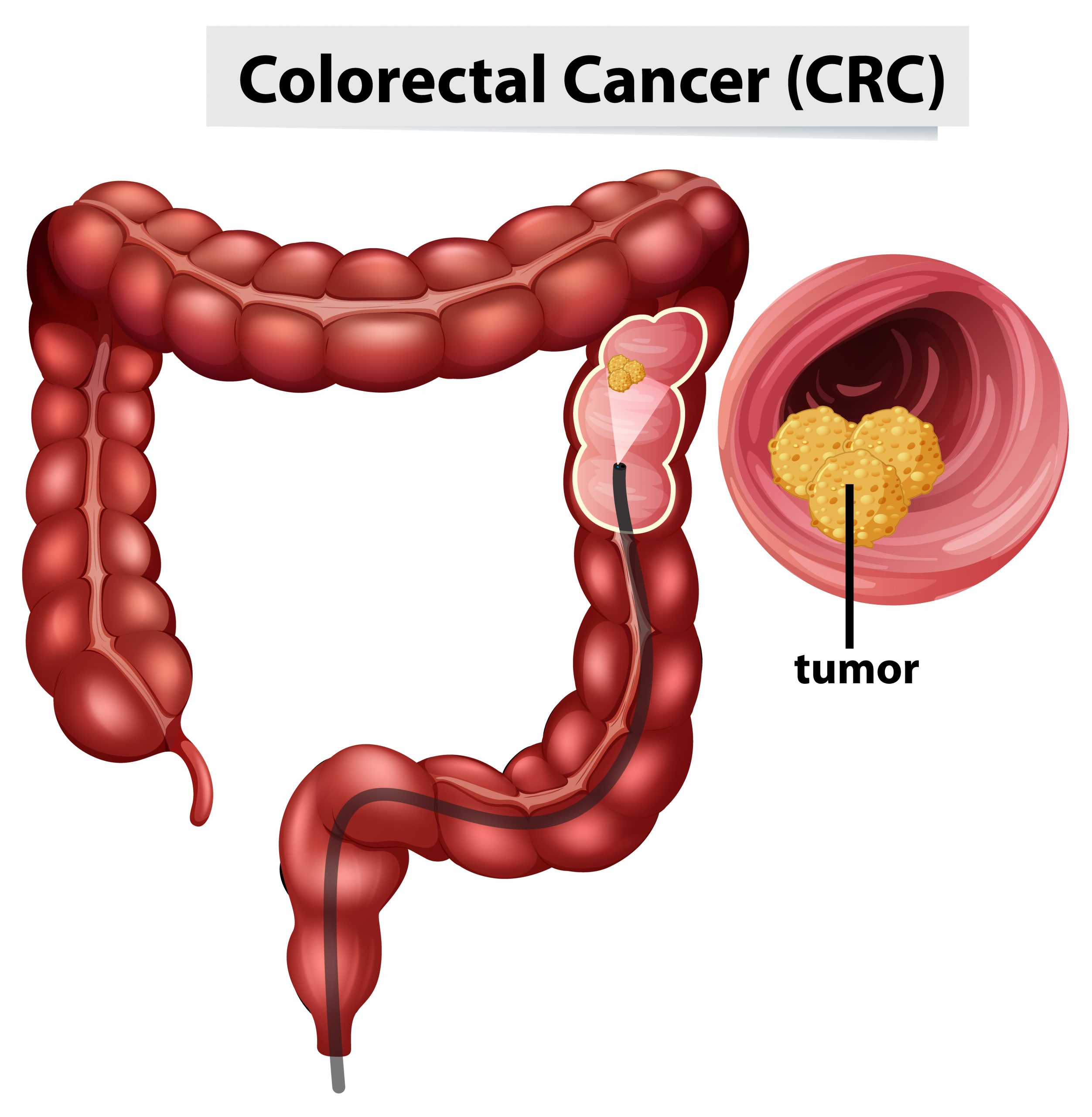 Approach to Metastases Classification in Colorectal Cancer