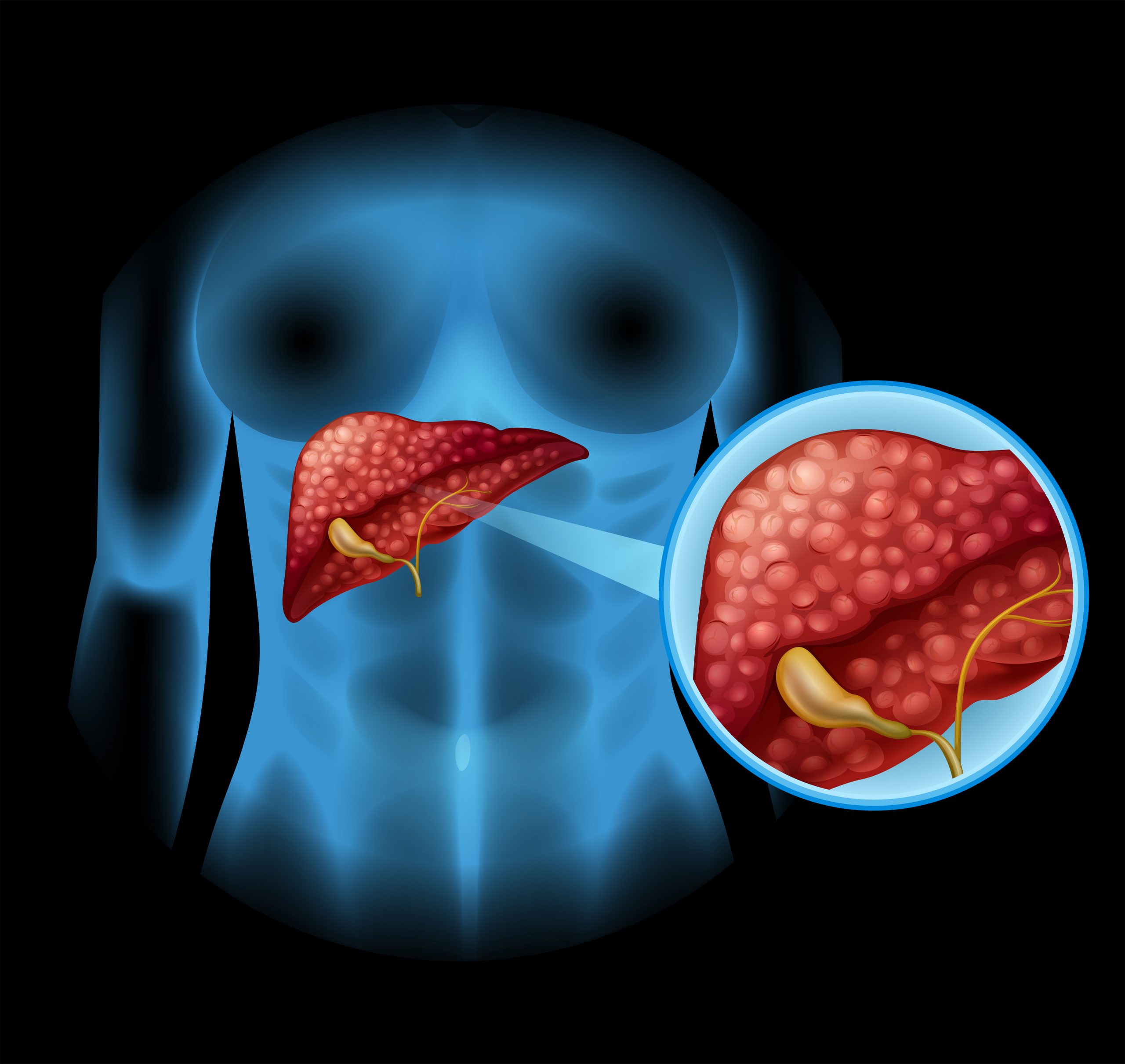 Pancreatic Cancer