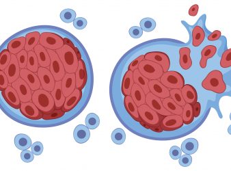 Study Shows T Cell Depletion Within Hours of Tumor Contact