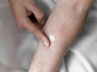 Methotrexate for Children with Severe Atopic Dermatitis