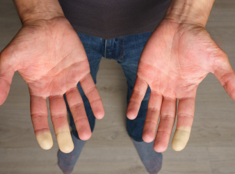 Genetic Etiology of Raynaud's Phenomenon Revealed