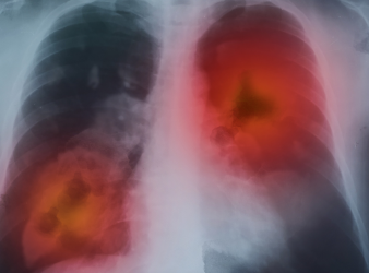 New Lung Cancer Tool From OHSU