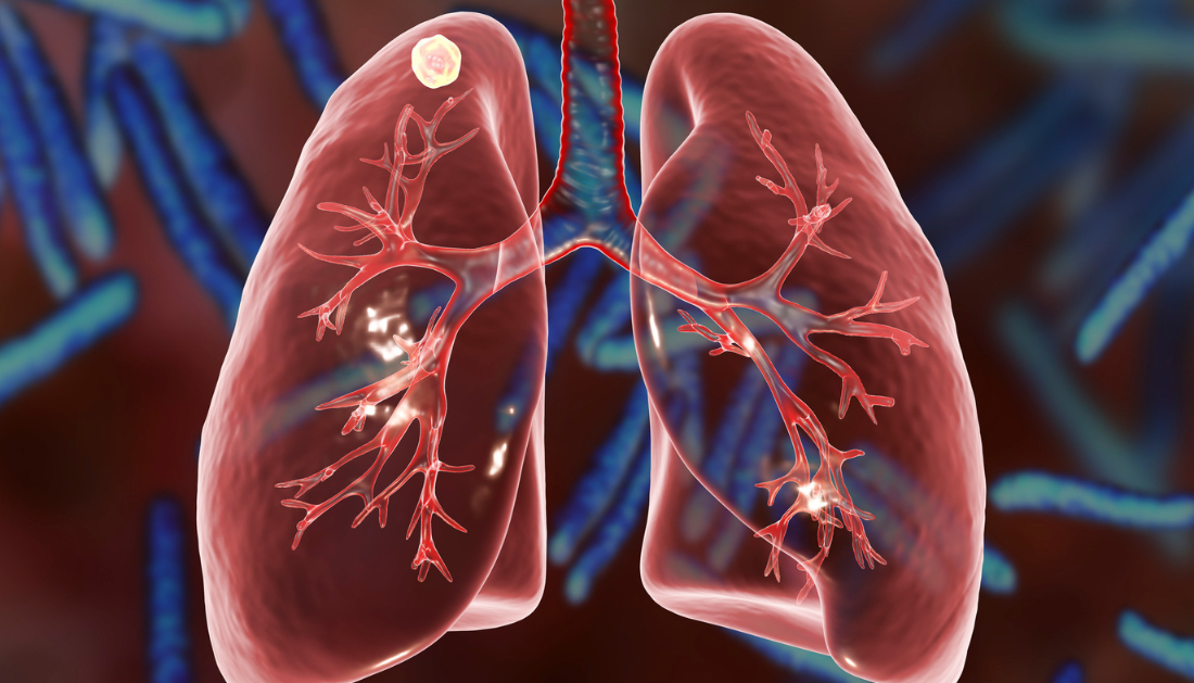 Disrupted NAD(H) Homeostasis may Treat Tuberculosis