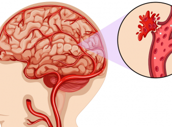 Elderly brain bleeding linked to blood vessel amyloid deposits