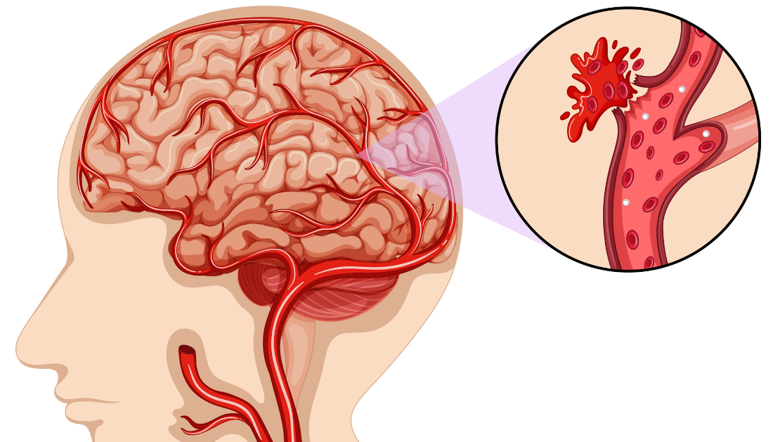 Elderly brain bleeding linked to blood vessel amyloid deposits