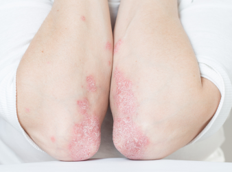 New treatment gives autoimmune skin condition patients hope