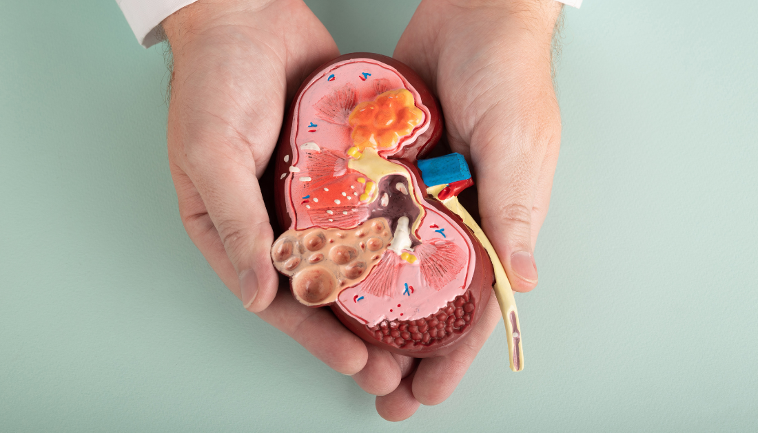 Kidney affected with CDK due to Ultr-processed Food(UPF)