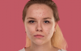 Young Women with Acne Vulgaris and Antioxidant Diet