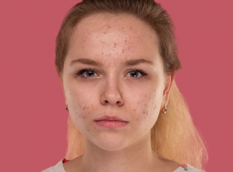 Young Women with Acne Vulgaris and Antioxidant Diet