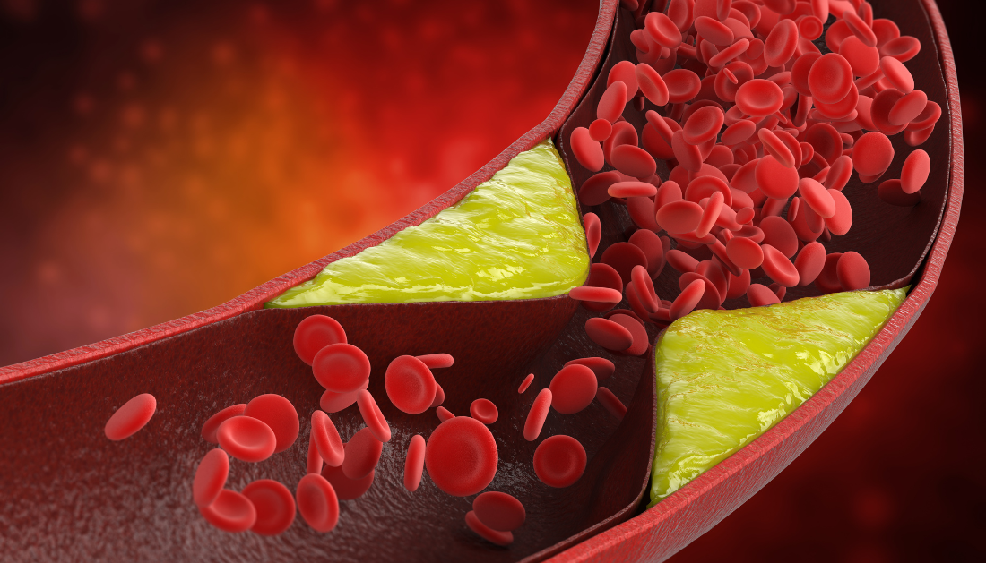 Image of a blood with a focus on cholesterol levels.