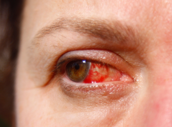 Image of a human eye with a highlighted cornea affected by Herpes Simplex Keratitis (HSK). pen_spark