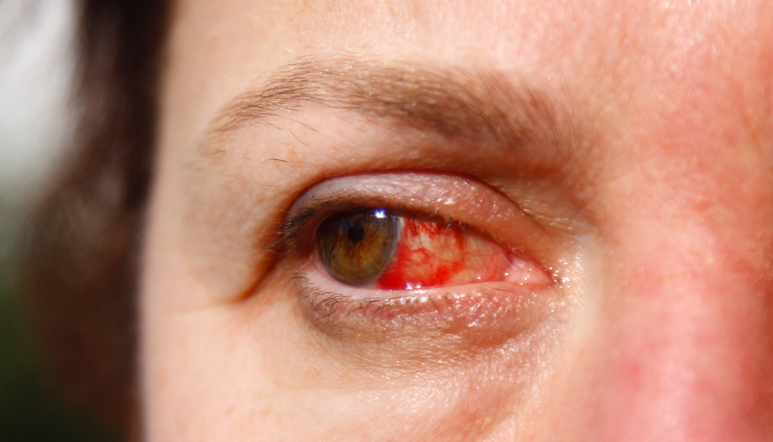 Image of a human eye with a highlighted cornea affected by Herpes Simplex Keratitis (HSK). pen_spark