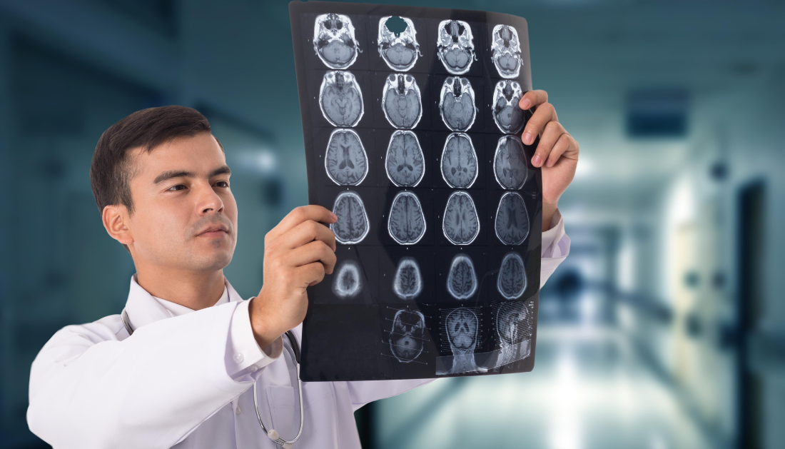 Magnetic resonance imaging (MRI) scan of a human brain, showing a dark area indicating a stroke.