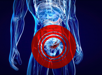 Promising Results of Total Neoadjuvant Therapy in Advanced Rectal Cancer Care