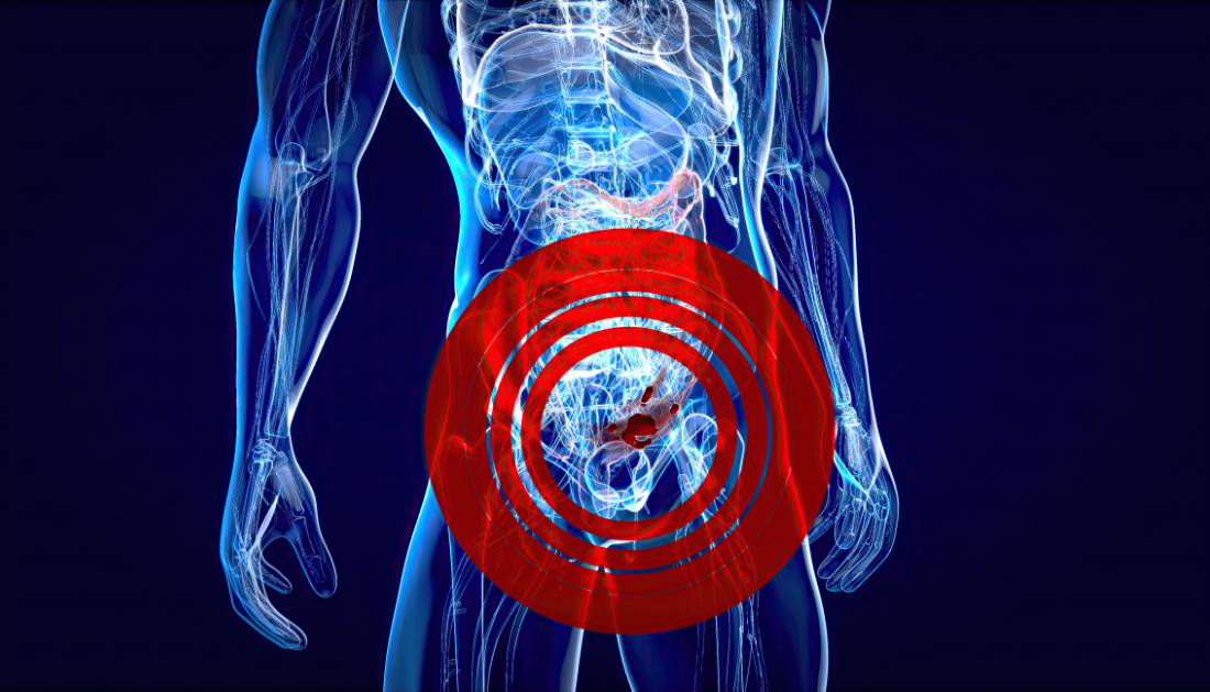 Promising Results of Total Neoadjuvant Therapy in Advanced Rectal Cancer Care