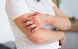 Cardiovascular Disease Linked with Psoriasis, Not Other Immune Diseases