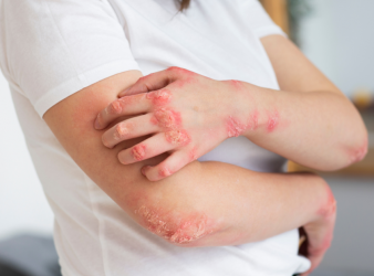 Cardiovascular Disease Linked with Psoriasis, Not Other Immune Diseases