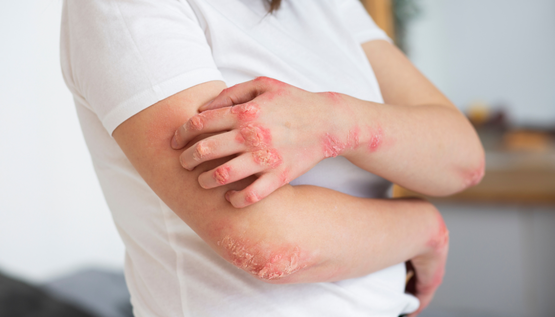 Cardiovascular Disease Linked with Psoriasis, Not Other Immune Diseases