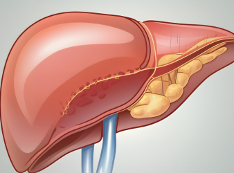 New Strategy to Prevent Fatty Liver: Study Insights