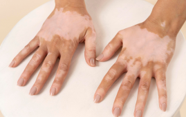 Vitiligo Increases Heart Disease & Stroke Risk, Study Reveals