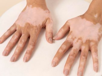 Vitiligo Increases Heart Disease & Stroke Risk, Study Reveals