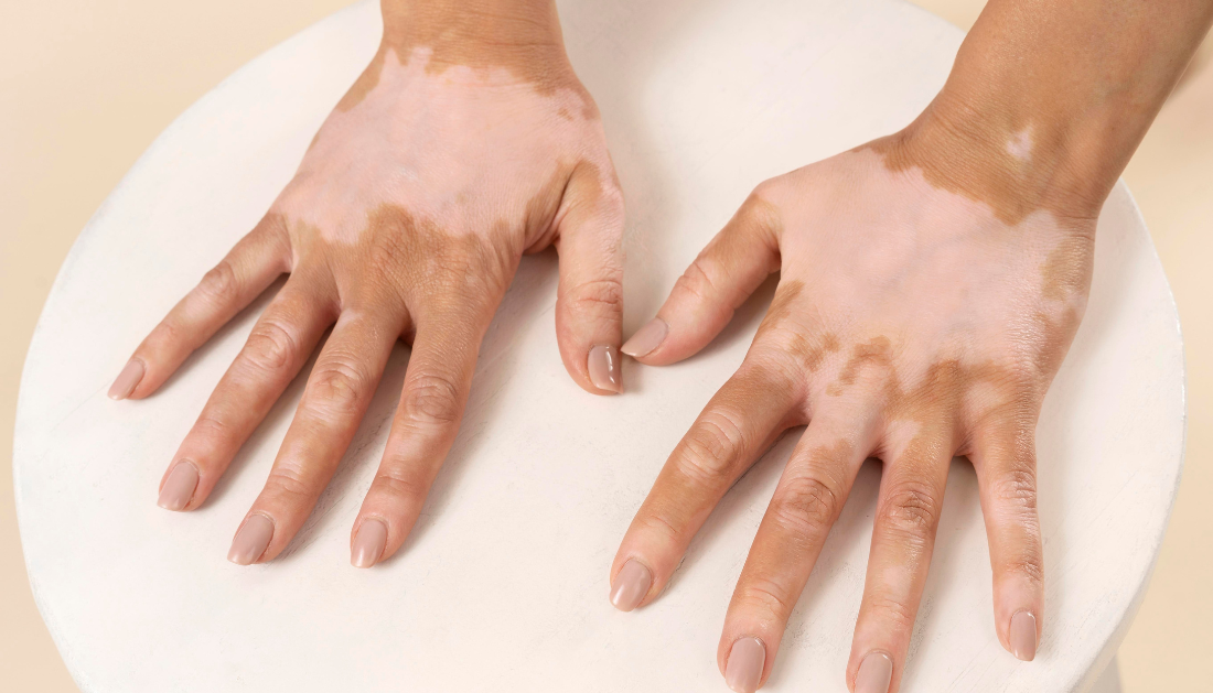 Vitiligo Increases Heart Disease & Stroke Risk, Study Reveals